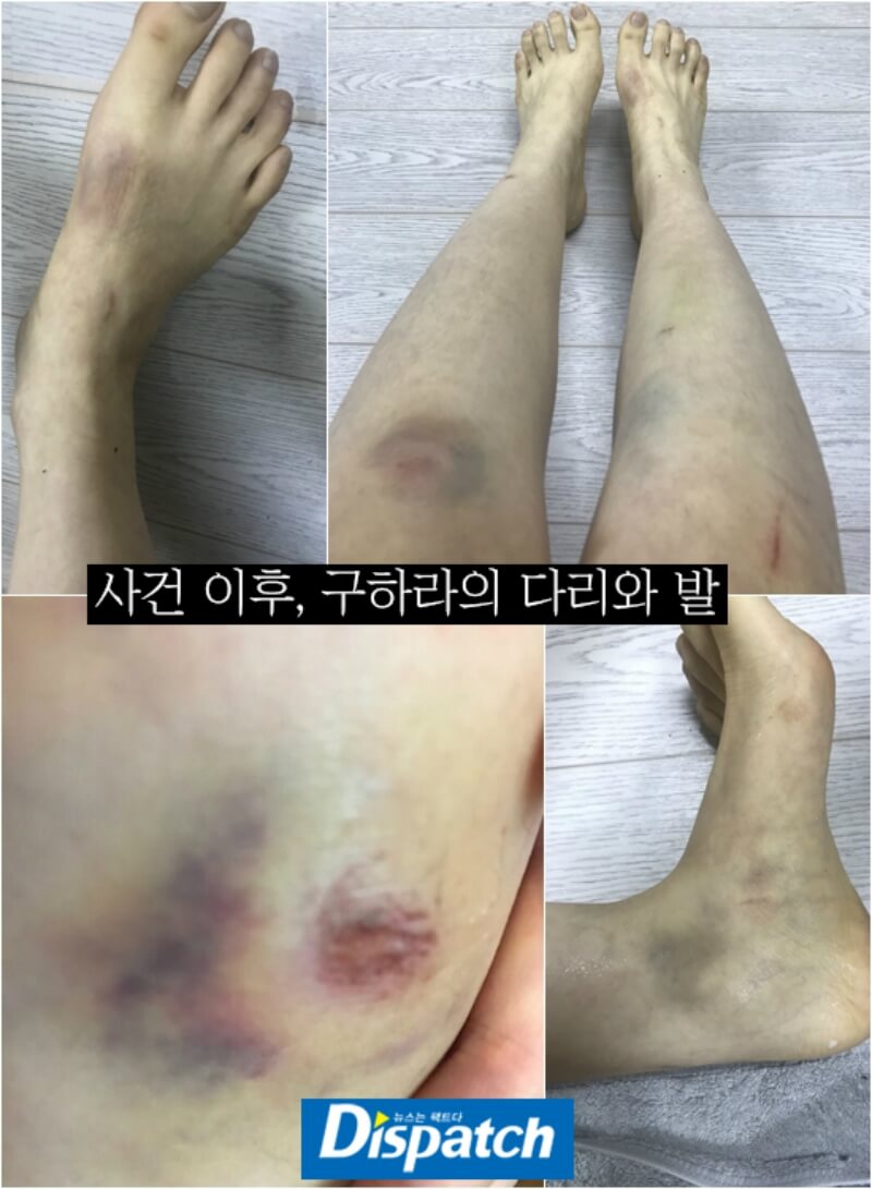 Những vết thương nghiêm trọng Choi Jong Bum gây ra cho Goo Hara